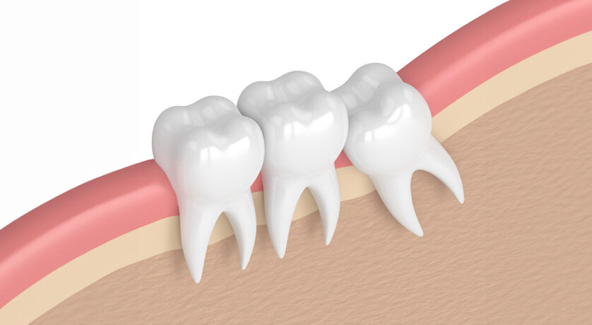 Wisdom Teeth Extractions