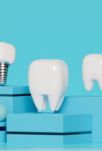 Mastering the Art of Long-Lasting Dental Implants: Your Ultimate Care Guide