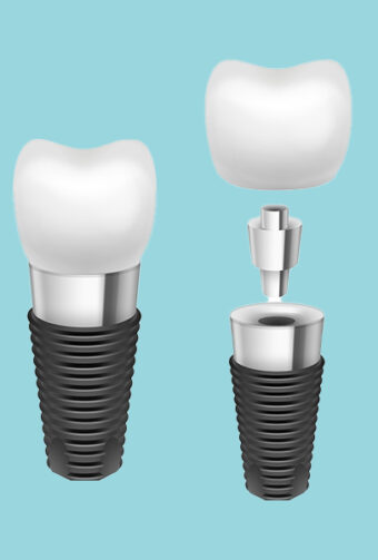 How Long Do Dental Implants Last? What Hackensack Residents Should Know