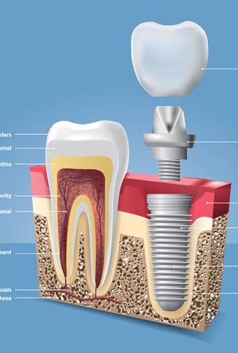 How Dental Implants Boost Your Oral Health and Quality of Life