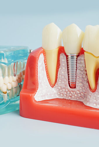 How to Care Best for Your Dental Implants to Ensure Long-Term Success