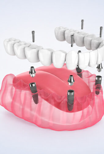 Why All-on-4 Implants are the Preferred Choice for Teeth Replacement?