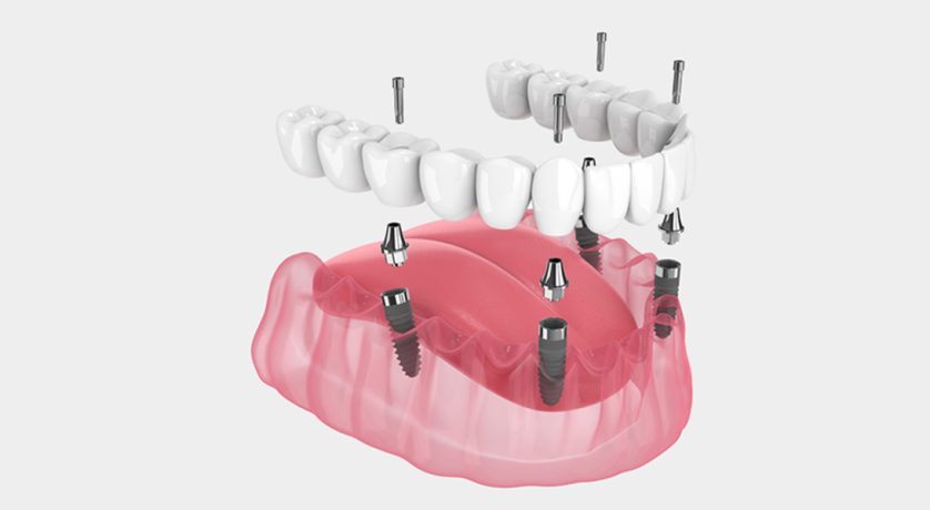 Why All-on-4 Implants are the Preferred Choice for Teeth Replacement?