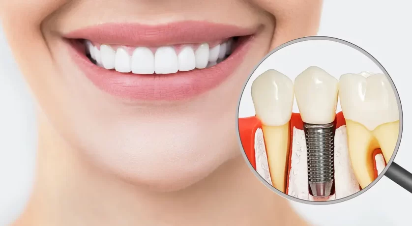 Dental implants in Hackensack, NJ.