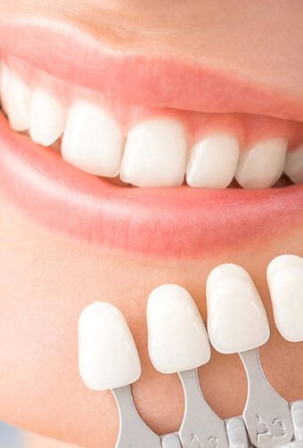 Matching teeth colour with dental veneers.