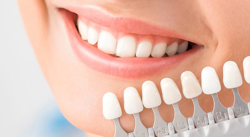 How to Choose the Right Dental Veneers for Your Smile Goals