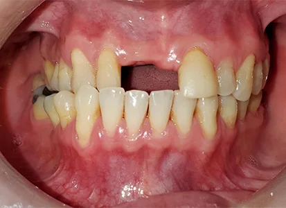 before-image