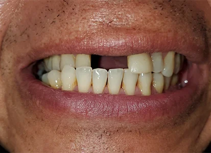 before-image