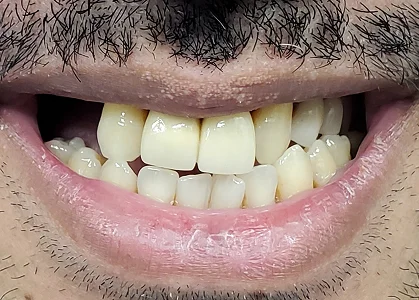 before-image
