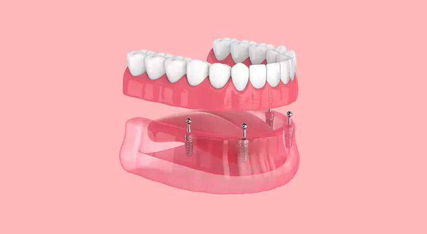 Benefits of Choosing All-on-4 Dental Implants Over Traditional Dentures