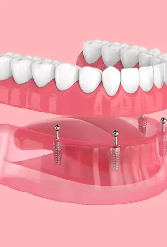Benefits of Choosing All-on-4 Dental Implants Over Traditional Dentures