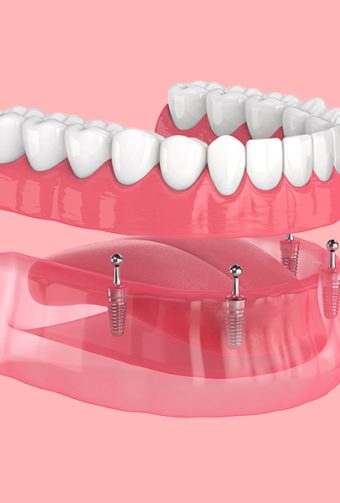 Maintaining Your Same-Day Dental Implants in Hackensack